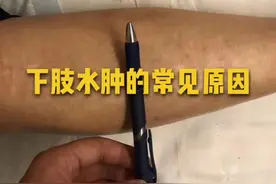下肢水肿的常见原因#问答王者 #清风计划 #我是抖音vlogge @南方健康 @头条健康视频封面