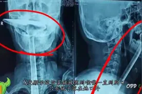 Top5：恐怖的头部X光片！视频封面