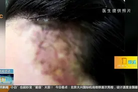 女子美容院打玻尿酸造成血管栓塞，脸部颜色变成深紫色