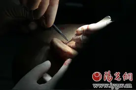 交大一附院再创奇迹！前臂再造耳成功移植患者头部成活图片