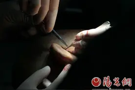 交大一附院再创奇迹！前臂再造耳成功移植患者头部成活图片