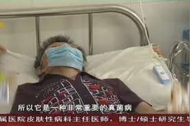 马尔尼菲篮状菌病发病率高不高？怎么预防马尔尼菲篮状菌感染？视频封面
