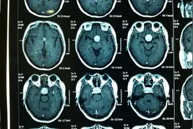 贺晓生教授：垂体瘤的微创治疗图片