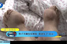 常吃海鲜还喝酒，痛风男子手脚长满“石头”视频封面