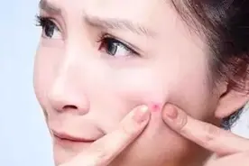 挤痘最强攻略：这样挤痘痘，真的不伤脸！视频封面