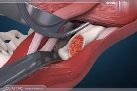 3D动画演示股骨头置换手术的全过程，看完后赶紧爱惜自己的身体吧视频封面