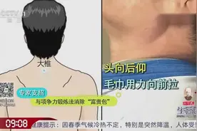 怎样才能消除“富贵包”？专家教你一项争力锻炼法，简单又实用视频封面