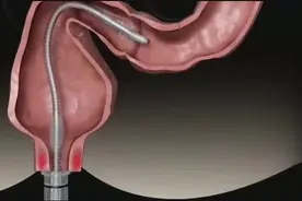 3D动画演示肠镜检查的全过程，非常直观