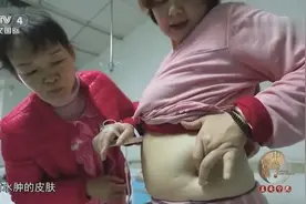 女子全身水肿情况严重，医生解释病因，竟跟生活起居不规律有关