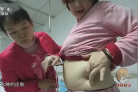 女子全身水肿情况严重，医生解释病因，竟跟生活起居不规律有关视频封面