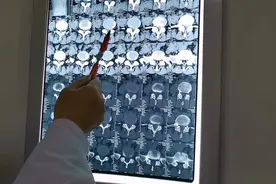 腰腿痛影像学诊断很重要！教你如何快速看懂腰椎间盘CT片