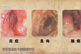 溃疡性结肠炎很危险！专家现场讲解，长期炎症变癌症的几率非常高视频封面