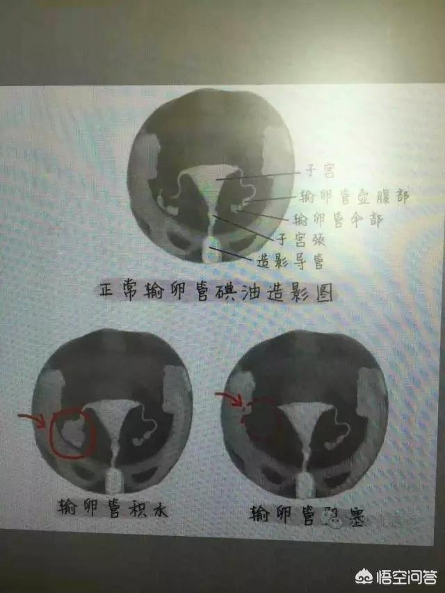 输卵管通畅的自测方法(怎么证明输卵管是通畅的)|母婴|人生攻略