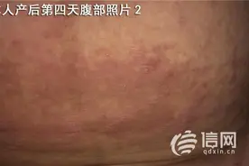 产妇小腹长起红疙瘩 青岛市立医院没换被褥？图片