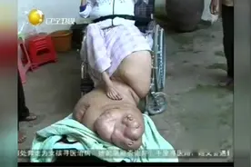 “象腿”女孩治疗之路令人心酸，海陆空千里营救终顺利抵达视频封面