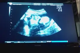 孕33周产检医生的讲解超细致，在他的解说下我终于看懂了B超图像