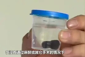 男子气管内惊现蚂蝗，在其体内存活1个月，因做了这件事引起的。视频封面