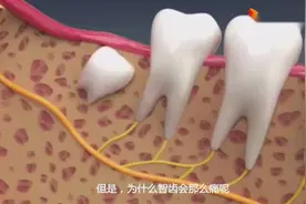 智齿为什么那么痛？动画展示原因，难怪说牙痛真要命！视频封面