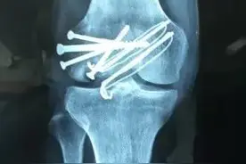 大块同种异体骨软骨移植治疗大面积全层软骨损伤伴骨缺损的经验图片