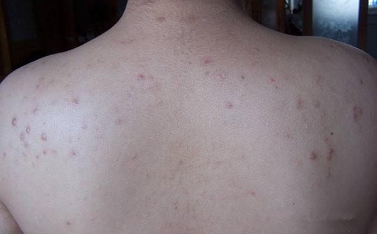 女性爱美是天性,到了夏天,自然想穿的清凉一些,但背后此起彼消的痘痘