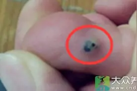 身上出现顽固黑色部分，可能是糖尿病前兆图片