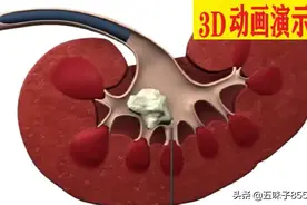 肾结石取出全过程（3D演示）视频封面