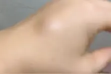 奇怪手被门把碰了一个小包出来唉……视频封面