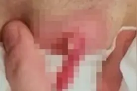 英国妹子狂挤痘痘，挤出的瞬间让我的胃阵阵筋挛！慎入图片