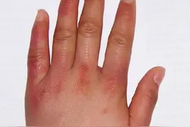 手冻了怎么办？会冻手的MM认真看看图片