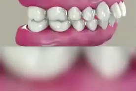 门牙外突，门牙缝大怎么办？#口腔 #牙齿矫正 #一秒变美视频封面