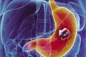 胃癌的具体部位在哪里？为什么被称为“穷癌”？