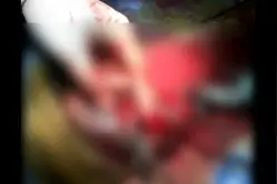 蛋疼！小伙网上自学自宫 将睾丸割下扔进马桶冲走 他说他想做变性手术又没钱视频封面