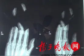 女子三只指头被机器咬断 医生10小时紧急手术手指神奇接上图片