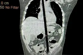 男童被竹竿穿体危在旦夕 专家八方赶来十小时通宵手术挽其性命图片
