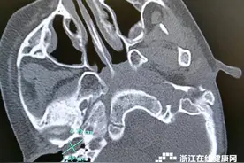 5岁男孩耳屎“指甲”大小硬似水泥 只好全麻手术取出图片