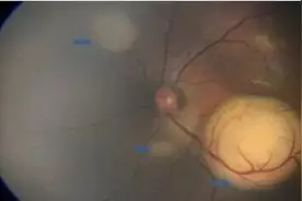 3岁女孩的眼睛到了晚上像猫眼一样会发光 医生建议：每一位新生儿都应做一次眼底筛查图片