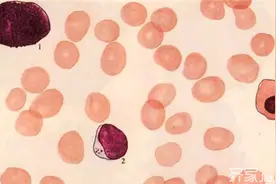 重型再生障碍性贫血 有哪些临床表现图片