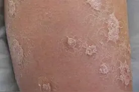 牛皮癣的症状及治疗方法，不要再相信那些“根治牛皮癣”的广告啦图片