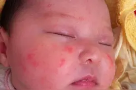 原来宝宝起红疙瘩是这么一回事，70%宝妈会忽视的细节图片