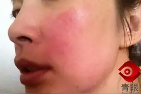 为什么皮肤过敏用大宝、郁美净有效？原因竟是这样图片
