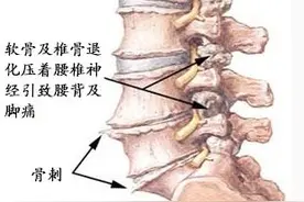 骨质增生不可怕，就像我的白头发！图片