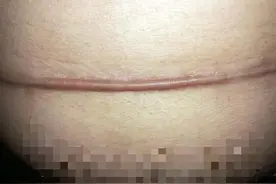 剖腹产宝妈看过来！刀口变成这样想死的心都有了！图片