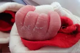 如果宝宝出现脱皮情况不要随便碰，小心感染！图片