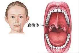 扁桃体发炎怎么办？吃哪些东西比较好？图片
