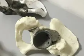 意大利首次在癌症治疗中使用3D打印钛金属骨骼植入物图片