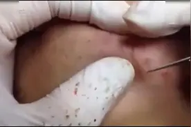 去除黑头的医生有意思，清除黑头还在手套上码整齐