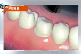 给牙带个“帽子”！专家现场讲解牙冠的修复过程