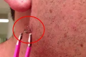 男子逆长毛发一年多，拔出后让人惊愕，慎入视频封面