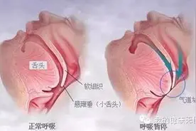 五招治好打鼾图片