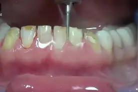 牙齿打磨整形视频视频封面